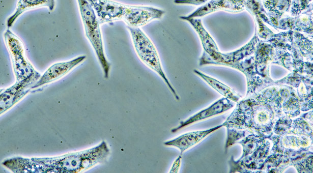 Prostate cancer cells